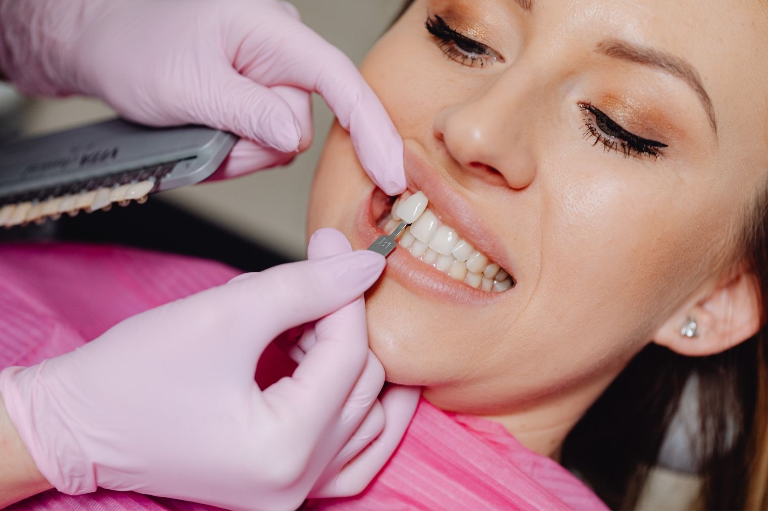 Dental veneers2