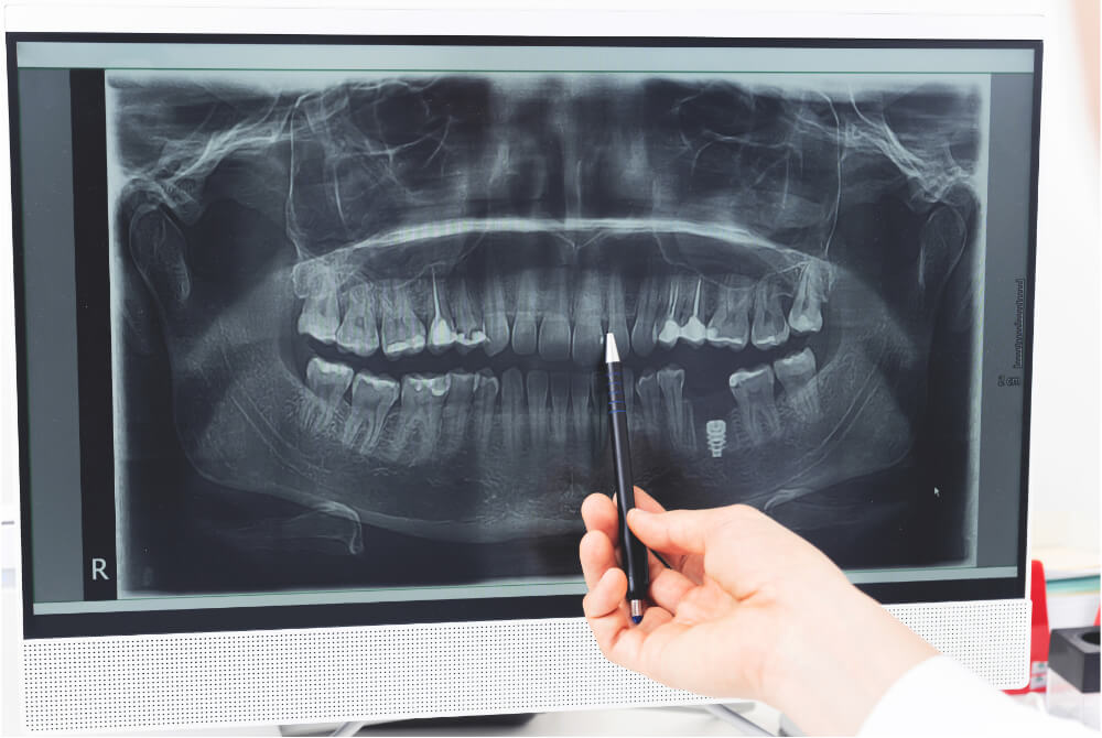Xray optimized